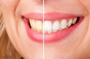 Advanced Teeth Whitening Strips (Dental Whitestrips)  - Slovensko - kúpiť - ako použiť
