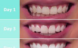 Snowhite Teeth Whitening – užitočný – cena – v lekárni