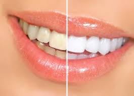 Oral Care - bielenie zubov - v lekárni - účinky - feeedback